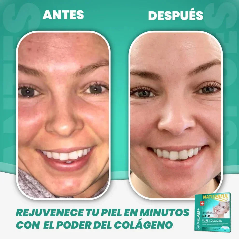 ¡¡¡2 X 1!!! Set de 6 Parches Colágeno Hidrosolubles para las mejillas