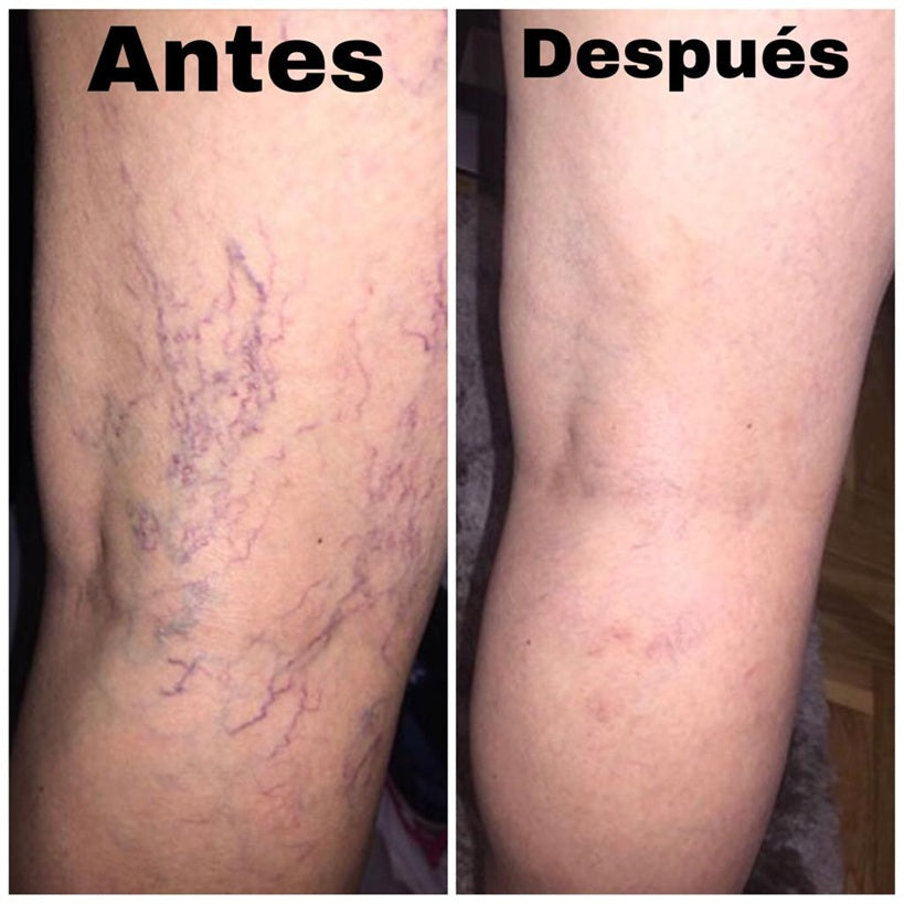 🦵🌿Spray Anti várices, dale el descanso merecido a tus piernas 💛